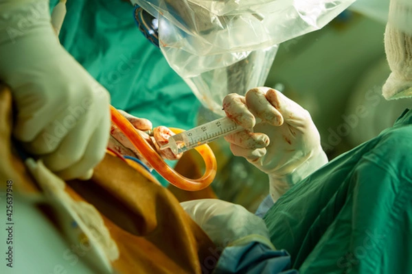 Fototapeta a surgeon performs an operation using a surgical microscope, close-up of a surgeon's assistant's hand with a syringe.
