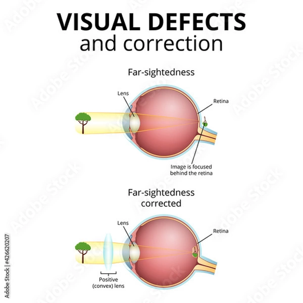 Fototapeta structure of the eyeball, visual impairment, farsightedness