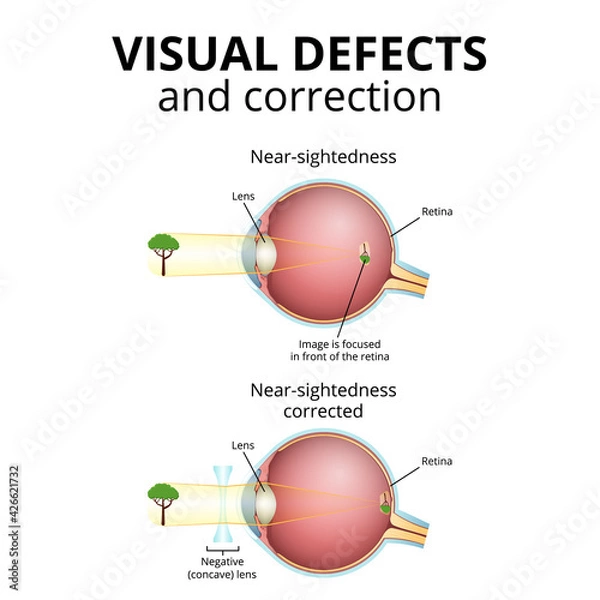 Fototapeta structure of the eyeball, visual impairment, near-sightedness