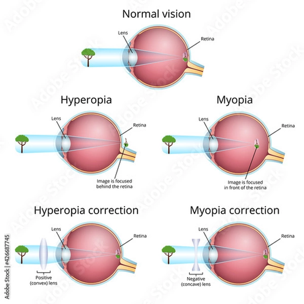 Fototapeta vision problems and their correction, myopia and hyperopia