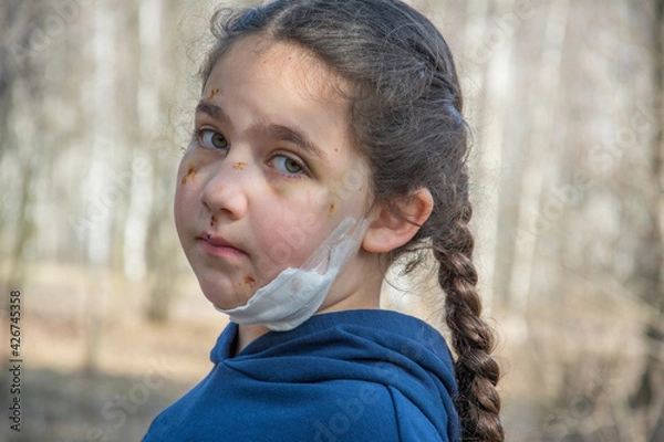 Fototapeta In the spring, in the forest, the girl's face is covered with scratches and bruises after a dog bite.