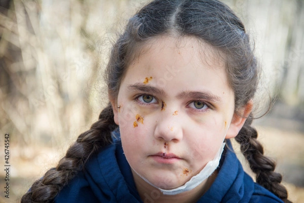 Fototapeta In the spring, in the forest, the girl's face is covered with scratches and bruises after a dog bite.