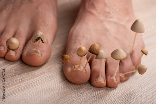 Fototapeta Fungi grow from the nail plates on the feet. Concept of nail fungus, skin and nail infections. Two legs with a fungus close-up in the background light.