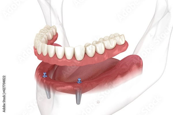 Fototapeta Mandibular removable prosthesis All on 2 system supported by implants with ball attachments. Medically accurate dental 3D illustration