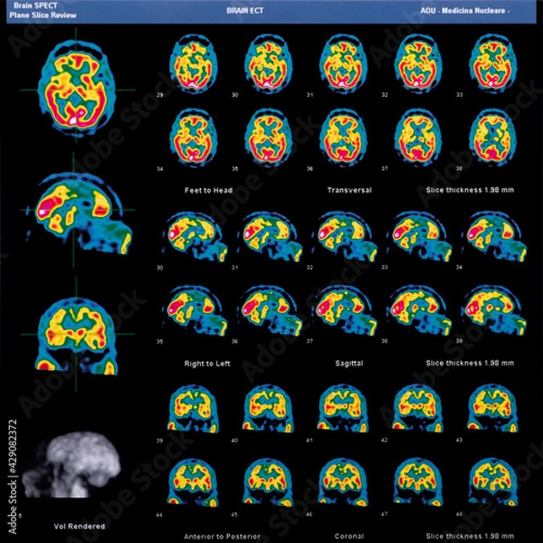 Fototapeta Brain SPECT of neurological patient. Color image of nuclear medical examination that represents a neurodegenerative disease. Sections of brain with severe pathology. Neurology studies and research.