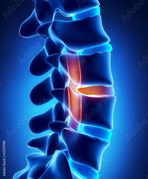 Obraz Herniated disc with pressure on spinal cord