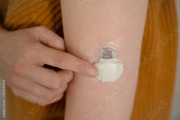 Fototapeta Continuous Glucose monitoring sensor on a diabetes patients arm
