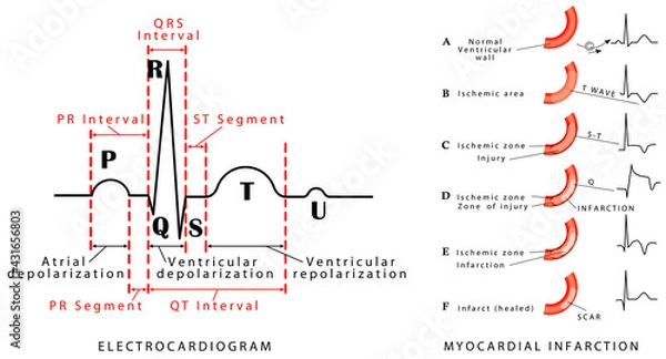 Fototapeta The heart cycle. Normal ECG. Myocardial infarction - ECG. Wave changes during evolution of myocardial damage. Myocardial infarction in the posterior wall and an occlusion of the circumflex artery.