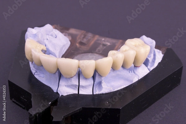 Obraz Dental bridge at laboratory