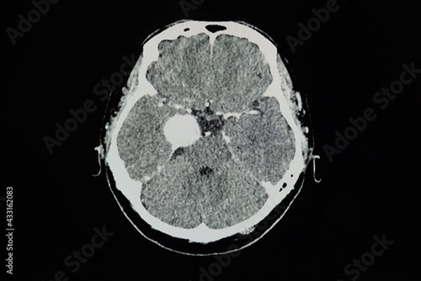 Fototapeta CT brain scan showing meningioma at right cavernous sinus.