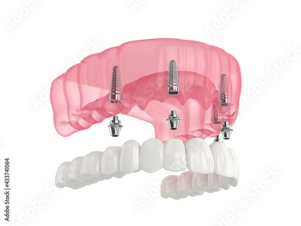 Obraz Mandibular prosthesis all on 4 system supported by implants