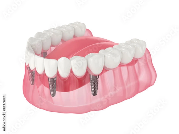 Fototapeta Mandibular prosthesis all on 4 system supported by implants