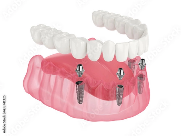 Fototapeta Mandibular prosthesis all on 4 system supported by implants