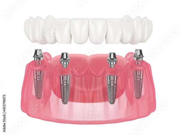 Fototapeta Mandibular prosthesis all on 4 system supported by implants