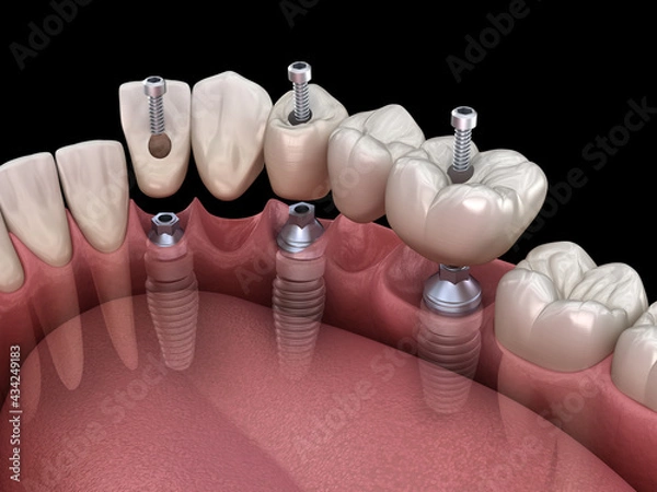 Fototapeta Dental bridge based on 3 implants. Medically accurate 3D illustration of human teeth and dentures concept