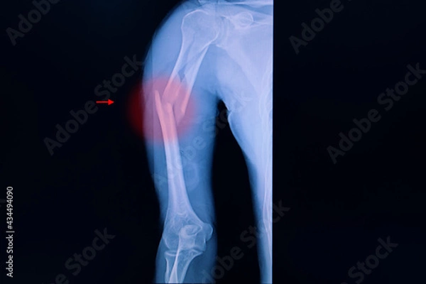 Fototapeta Xray film of an arm with fractured humerus.