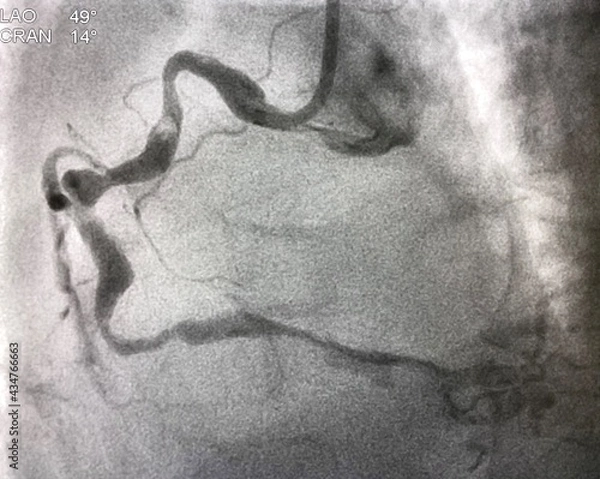 Fototapeta coronary angiogram shown massive thrombus that occluded right coronary artery (RCA) in patient with ST elevation myocardial infarction (STEMI).