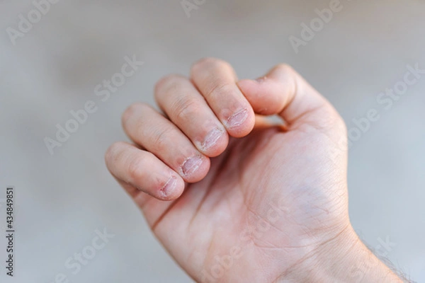 Fototapeta A man's hand with bitten and ugly fingernails. Bad care of hands