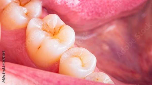 Fototapeta Symptoms of demineralization of the teeth. Visible signs of caries in the interstices of the enamel of  the tooth. Dental damaged erosion concept. Loss of the reinforcement of the enamel.
