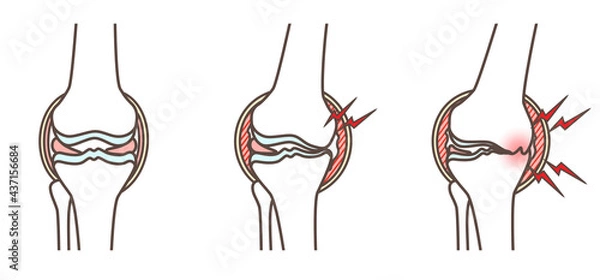 Fototapeta 変形性膝関節症のイラスト