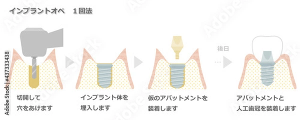Obraz インプラントオペ（1回法）