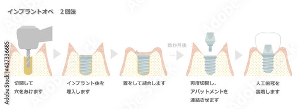 Obraz インプラントオペ（2回法）