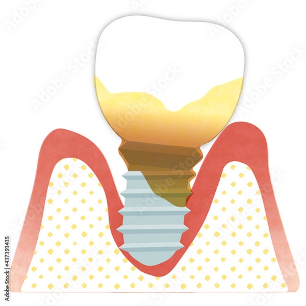 Obraz インプラント歯周炎（重度）