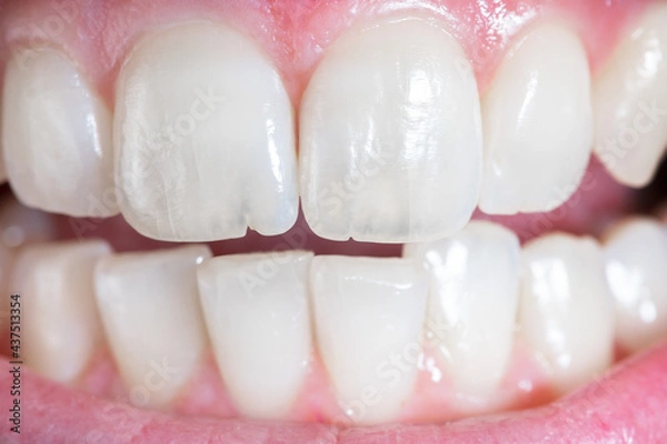 Fototapeta Concept of microfractures on the dental surface. Slight superficial dentin crack. Damage to the tooth due to incorrect chewing, very hard food or bruxism.