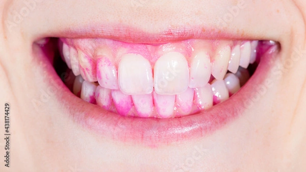 Fototapeta Concept of deep and detailed cleaning of the teeth. Pink disclosing tablets or gel for reveal and remove plaque and tartar. Removal of yellow plaque. Self inspection of plaque.