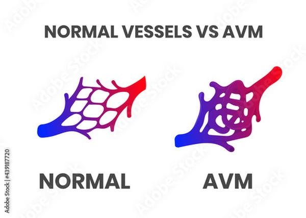 Obraz Normal vessels and arteriovenous malformation (avm)