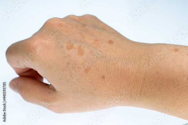 Obraz 手の甲のシミに悩む女性の右手