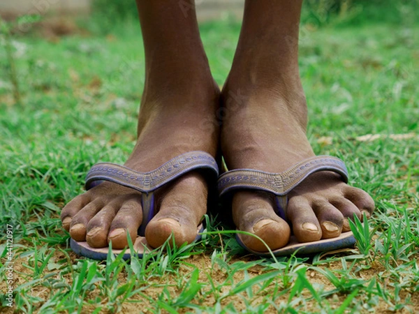 Obraz Poor boy feet with sleeper closeup