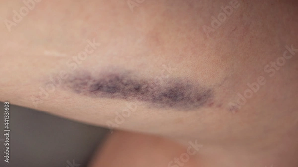 Obraz Big bruising on a woman's thigh.