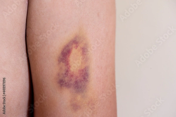 Fototapeta Bruise on man arm. Injection bruises.