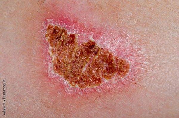 Obraz Burn scar