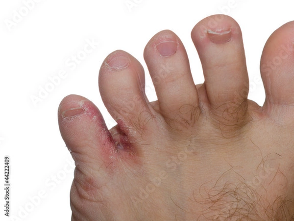 Obraz Foot fungus