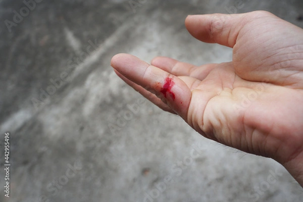 Fototapeta Fresh wound on the little finger.