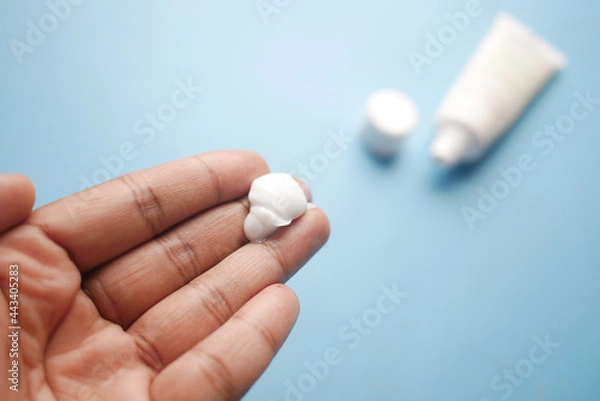 Fototapeta Man applying antibiotic cream close up