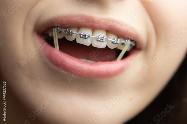 Fototapeta Closeup of a woman with braces wearing power chains and orthodontic elastics to correct her bite.