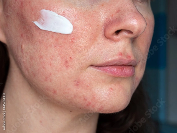 Obraz medicated ointment on woman face with rosacea close up