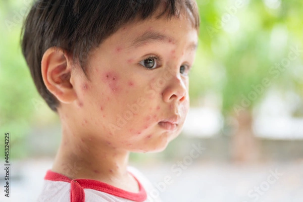 Fototapeta Portrait of sick little  boy. Varicella virus or Chickenpox bubble rash on child