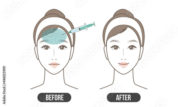 Obraz しわ　治療（シンプル）