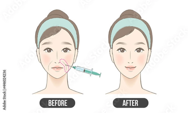 Obraz ほうれい線　治療（カラー）