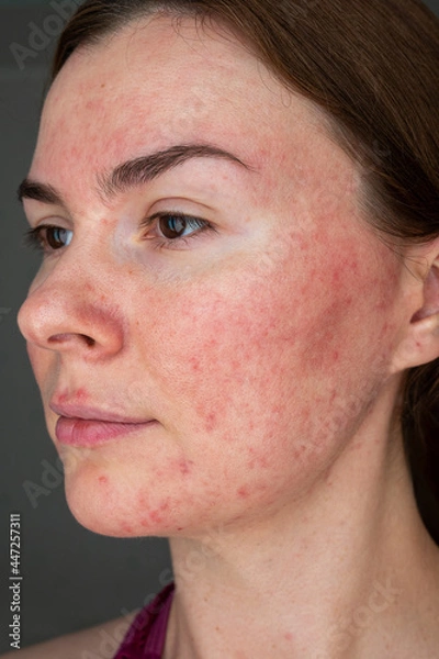 Obraz papulopustular rosacea, face close up