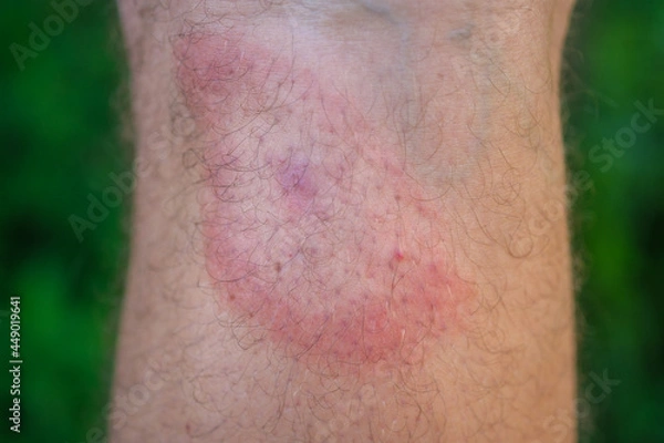 Fototapeta migrating erythema after a tick bite on a man's leg. a symptom of tick-borne borreliosis. a red ring in the form of a target on the leg