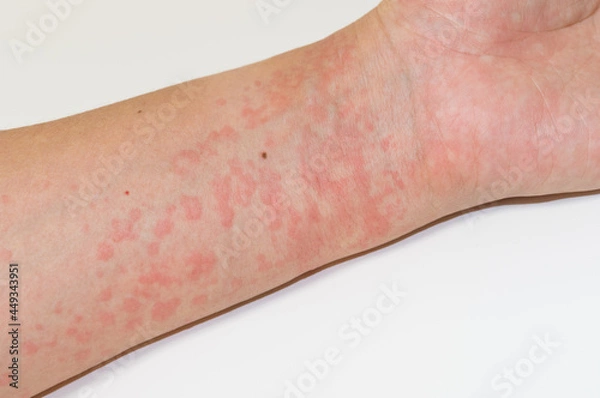 Fototapeta 蕁麻疹の症状