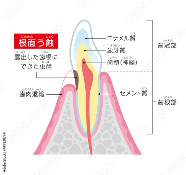 Obraz 根面う蝕の図解イラスト