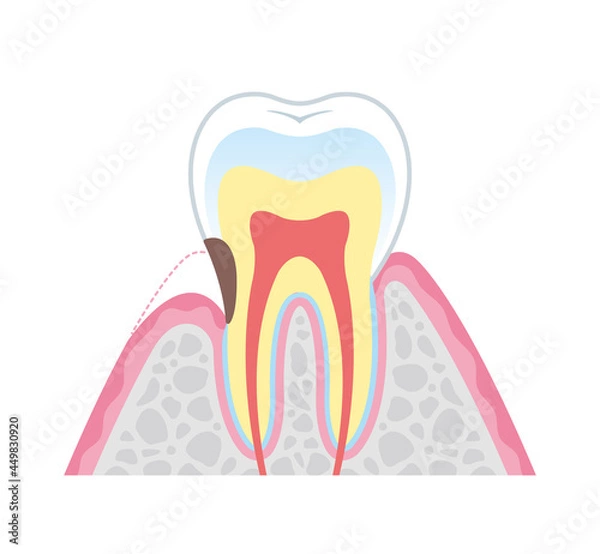Obraz 根面う蝕の図解イラスト