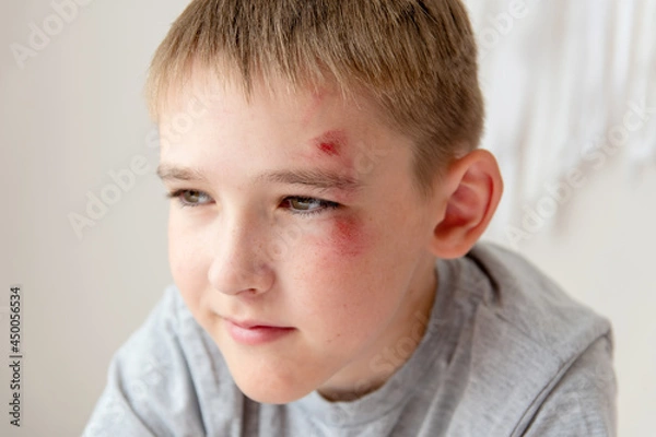 Fototapeta Portrait of a boy of 10 years with an abrasion on his face from a fall or fight.