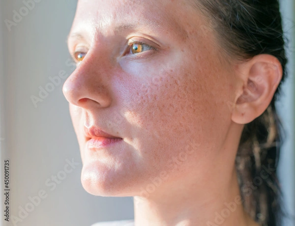 Obraz Woman with problematic skin and acne scars. 